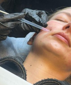Skin Treatment